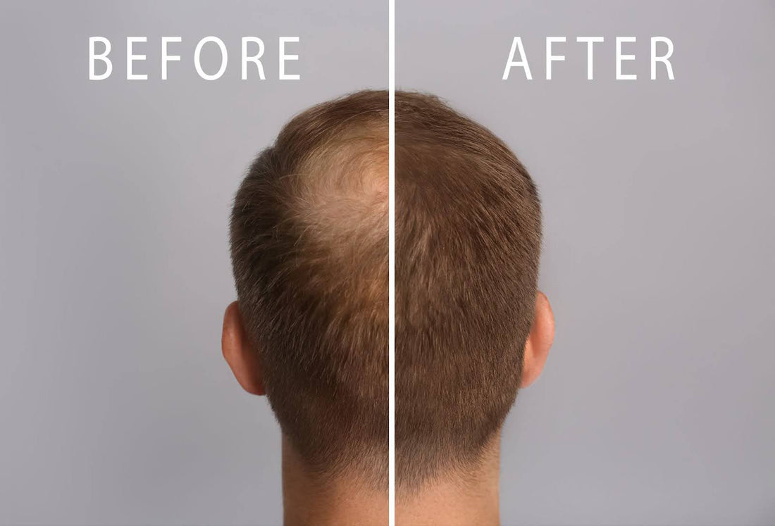 The Real Reason Men Lose Their Hair — And How to Stop It Naturally