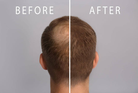 The Real Reason Men Lose Their Hair — And How to Stop It Naturally